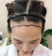 发际线植发多少钱，2021年植发价格表请查收~