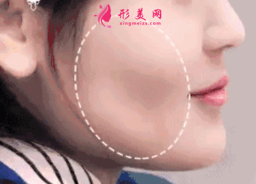 自体脂肪填充脸部一般要注射几次