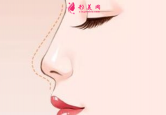 自体软骨隆鼻效果好不好呢？