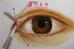 开眼角的价格费用是多少?