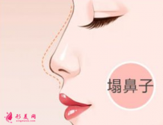 自体软骨隆鼻术后效果多久稳定