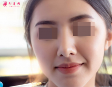自体脂肪填充脸部肿胀期是多久？