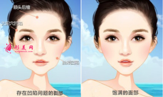 自体脂肪填充面部要忌口多久