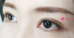 双眼皮手术常见的风险一般有哪些？