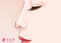假体隆鼻术后的效果好看吗？