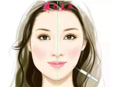 瘦脸针打了有用吗