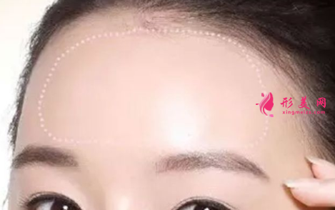 自体脂肪填充脸部后效果好吗