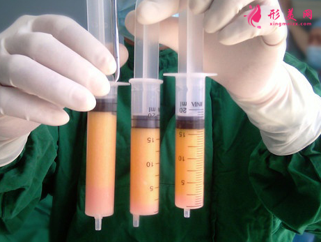 自体脂肪填充额头术后要注意什么