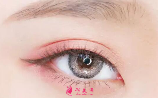 埋线双眼皮术后怎么护理