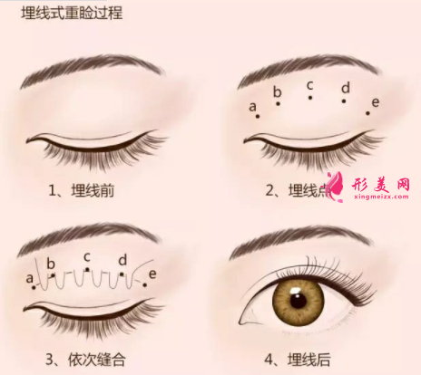 埋线双眼皮费用是多少