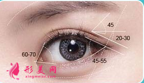 开眼角术后护理需要注意什么