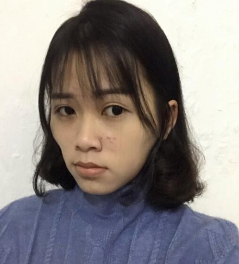 上海九院颧骨内推多少钱？全新价格表来袭！附案例分享