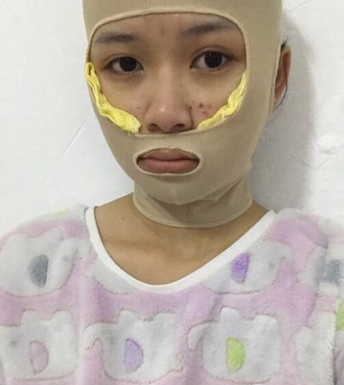 上海九院颧骨内推多少钱？全新价格表来袭！附案例分享