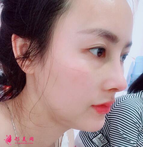 眼部整形手术价钱是多少？术后注意事项是什么？