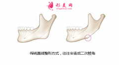 明星都做哪些轮廓整形手术，为什么很多人不建议做下颌角？