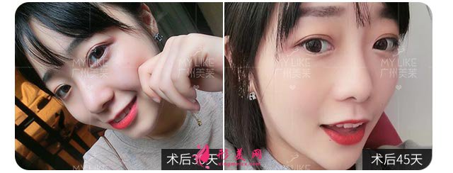 双眼皮手术是怎么做的