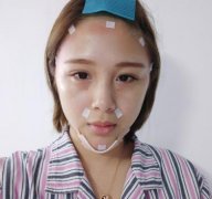 秦皇岛市中医院医学美容科自体脂肪全脸填充案例一览！含全新价格