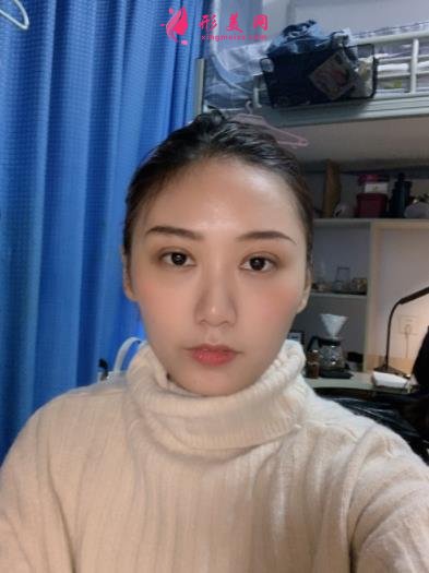 郑东美眼医疗美容怎么样？双眼皮案例效果反馈图及价格费用清单查询
