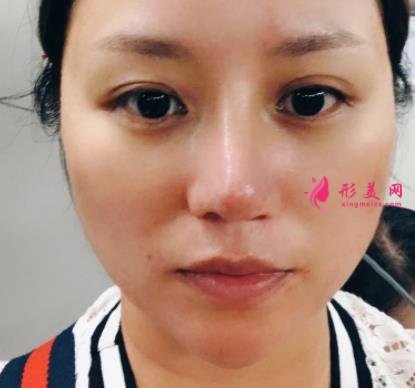 南昌大学二附院整形科去眼袋怎么样?对比下真人案例及价格均价表