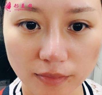 南昌大学二附院整形科去眼袋怎么样?对比下真人案例及价格均价表