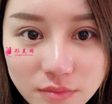 南昌大学二附院整形科去眼袋怎么样?对比下真人案例及价格均价表
