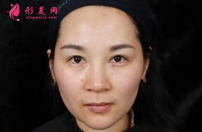 四川华西医院整形科玻尿酸丰太阳穴案例查询！含2021全新价格表公示