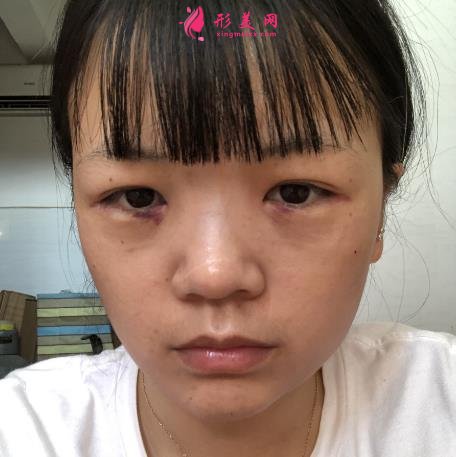 浙江省中医院车菲挂号容易吗?去眼袋多少钱？附案例参考