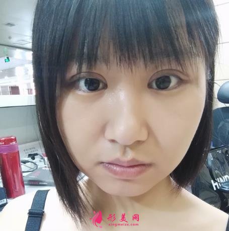 延安市人民医院整形科怎么样？2021双眼皮手术恢复过程图分享