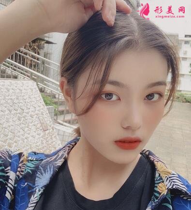 北京中日友好医院整形外科磨骨案例分享，附价格表新版费用
