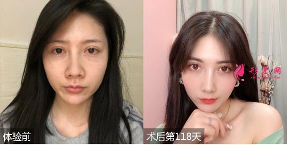 深圳福华医院整形价格表2020！有隆鼻效果为大家展示！