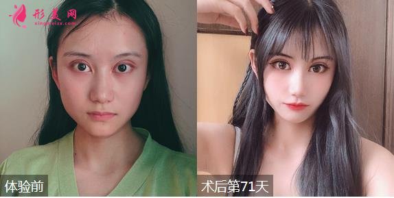 深圳福华医院整形价格表2020！有隆鼻效果为大家展示！
