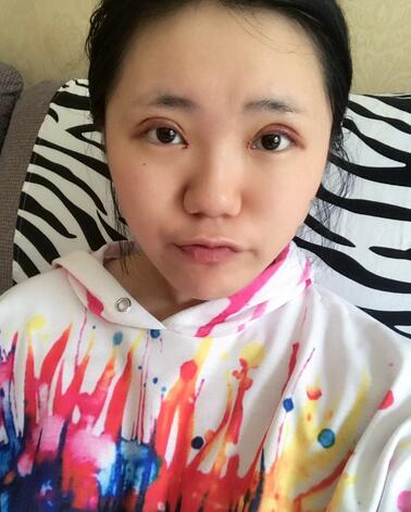 成都美未央双眼皮恢复过程日记