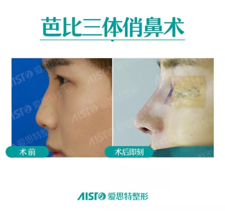 聊一聊厦门做耳软骨隆鼻多少钱