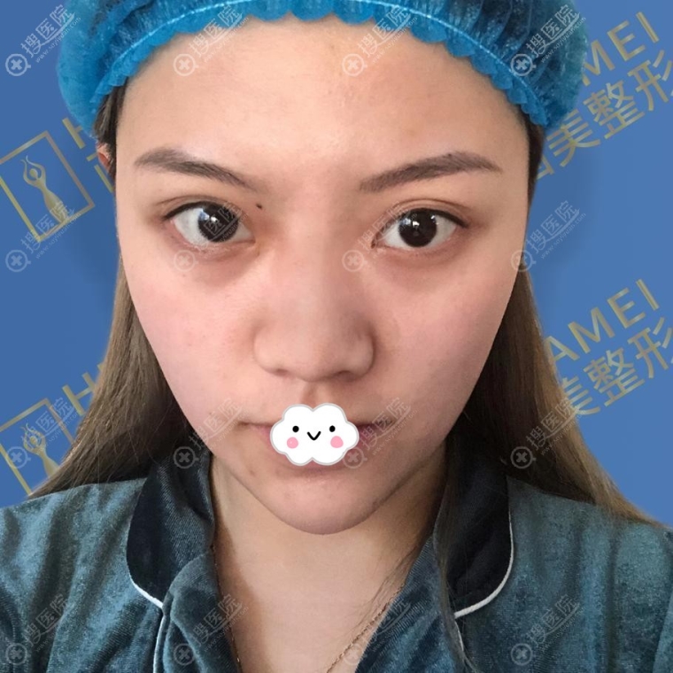 图文解答南京整鼻子多少钱