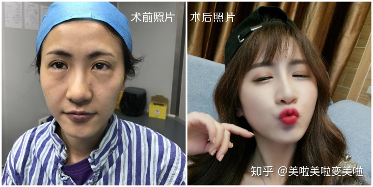 关于解答北京整鼻子要多少钱