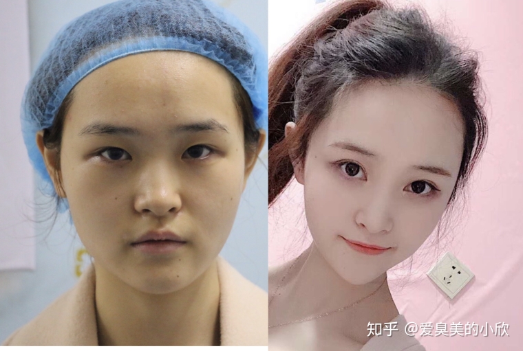 老医生给你说苏州胸部整形价格