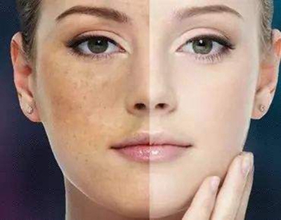 福州e光美白祛斑价格贵吗 哪家医院好 轻松有效 塑造美白肌