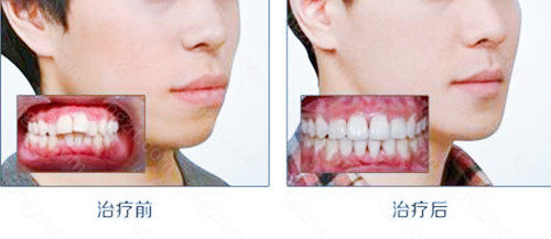 苏州正规牙齿矫正医院有哪些?推荐几家口碑好的口腔医院