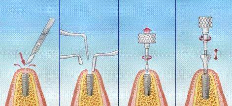 天津种牙哪个医院好?从医生技术上为您推荐