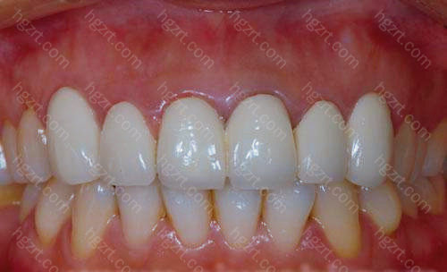 威兰德和爱尔创哪个好?国产全瓷牙和进口全瓷牙的区别是啥?