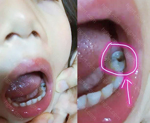 儿童龋齿补牙就是个骗局，小孩子补牙材料三个月就掉了