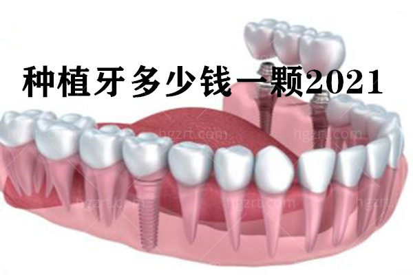 想知道种植牙多少钱一颗2023价格表，看这一篇就够了