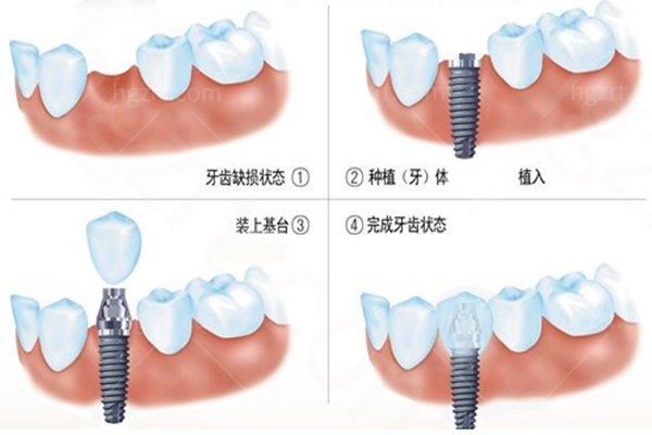 了解即拔即种植牙的利与弊，看即刻种植和即刻负重的区别