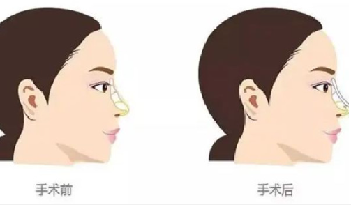 伊维兰注射隆鼻后再做假体隆鼻行吗？需要间隔多久？