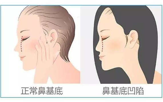 上海地区鼻基底填充价格贵吗？有哪些医生值得推荐