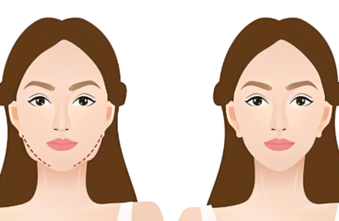 杭州艺星整形医院面部吸脂收费怎么样?更有该院面吸技术实力解析 杭州艺星整形医院面部吸脂收费怎么样?更有该院面吸技术实力解析